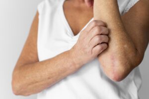 epilarea definitiva si psoriazisul